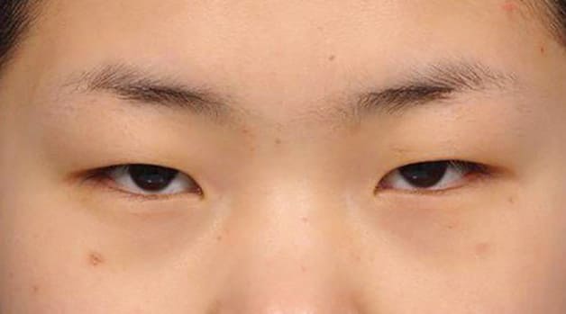mí sụp có nên cắt mí 