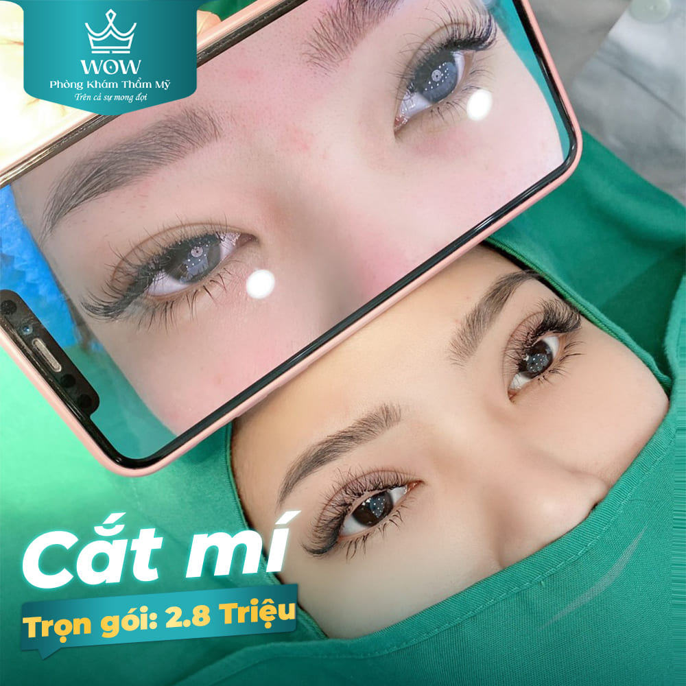 mí sụp có nên cắt mí 