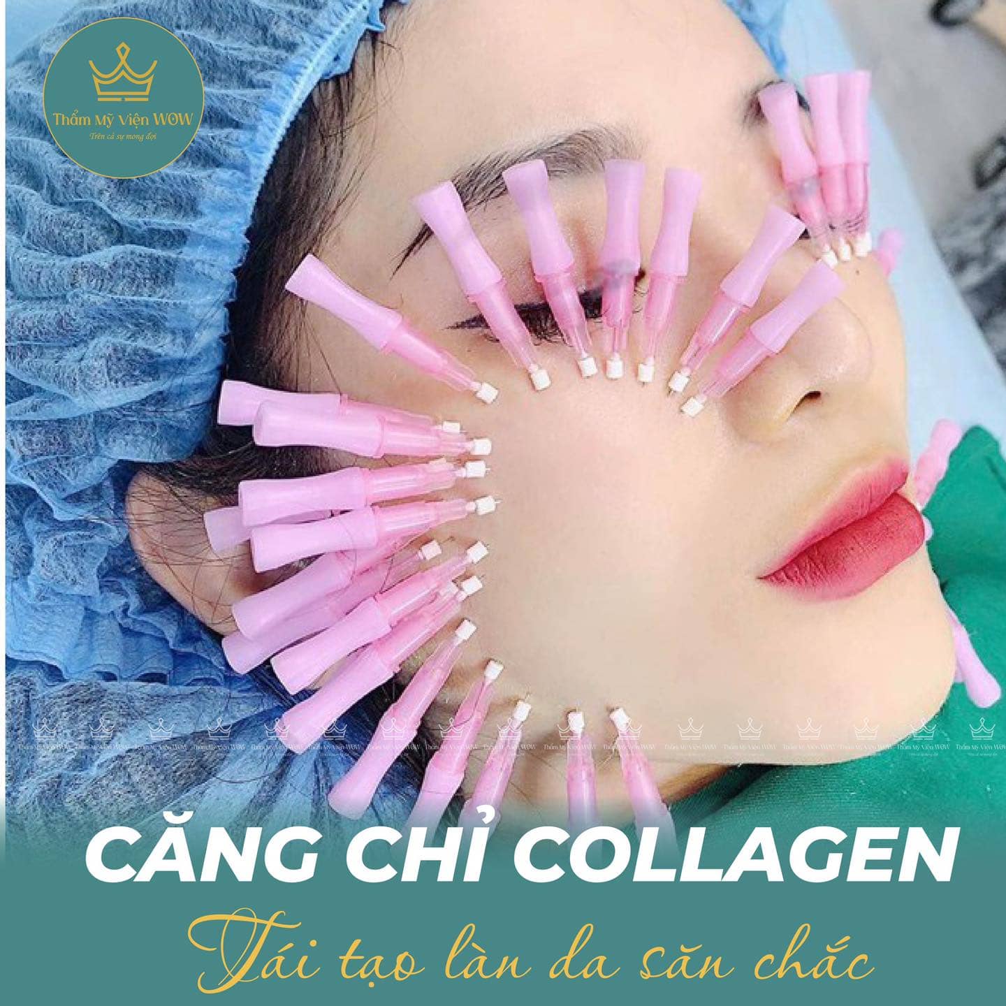 Căng chỉ collagen có an toàn không