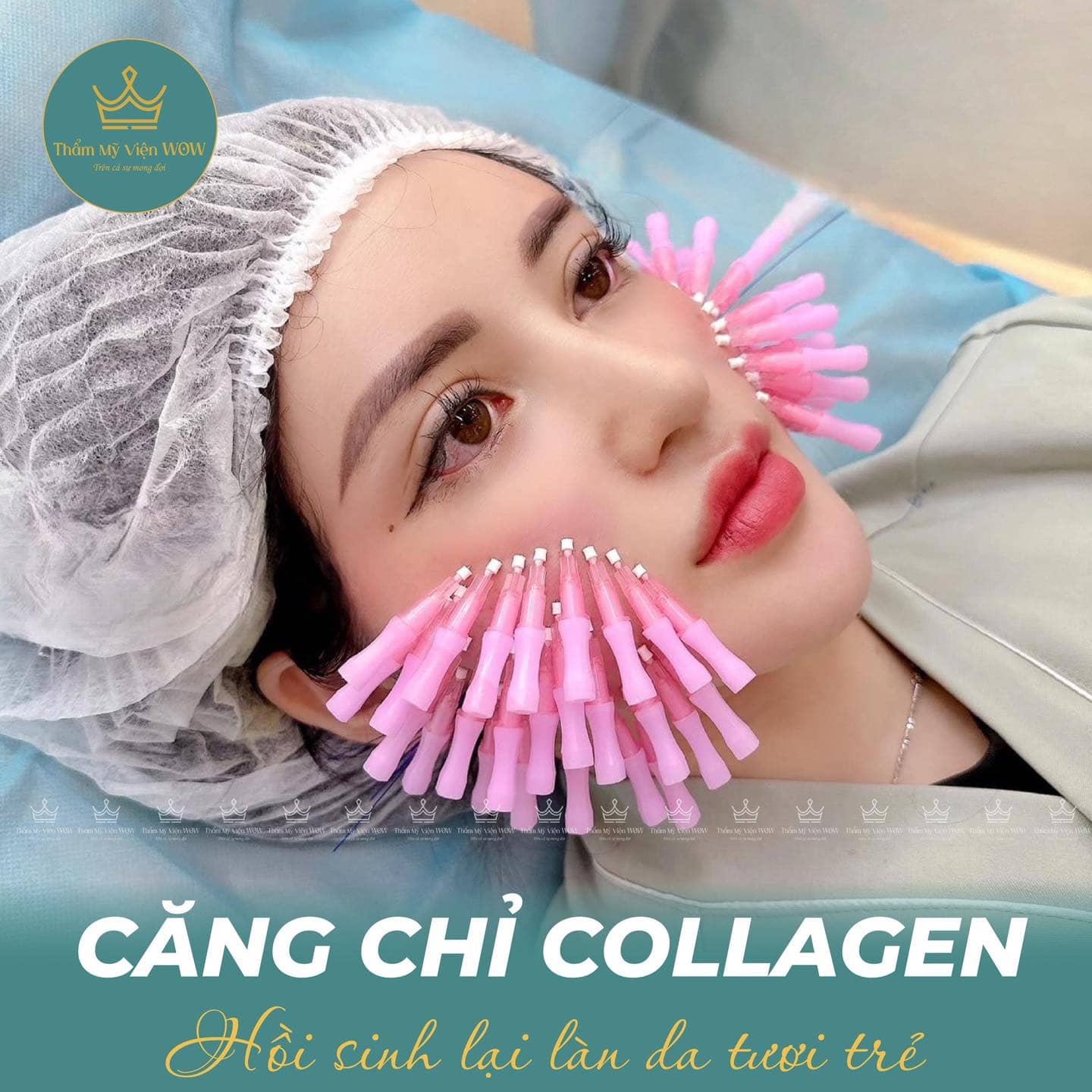 Căng chỉ collagen có an toàn không