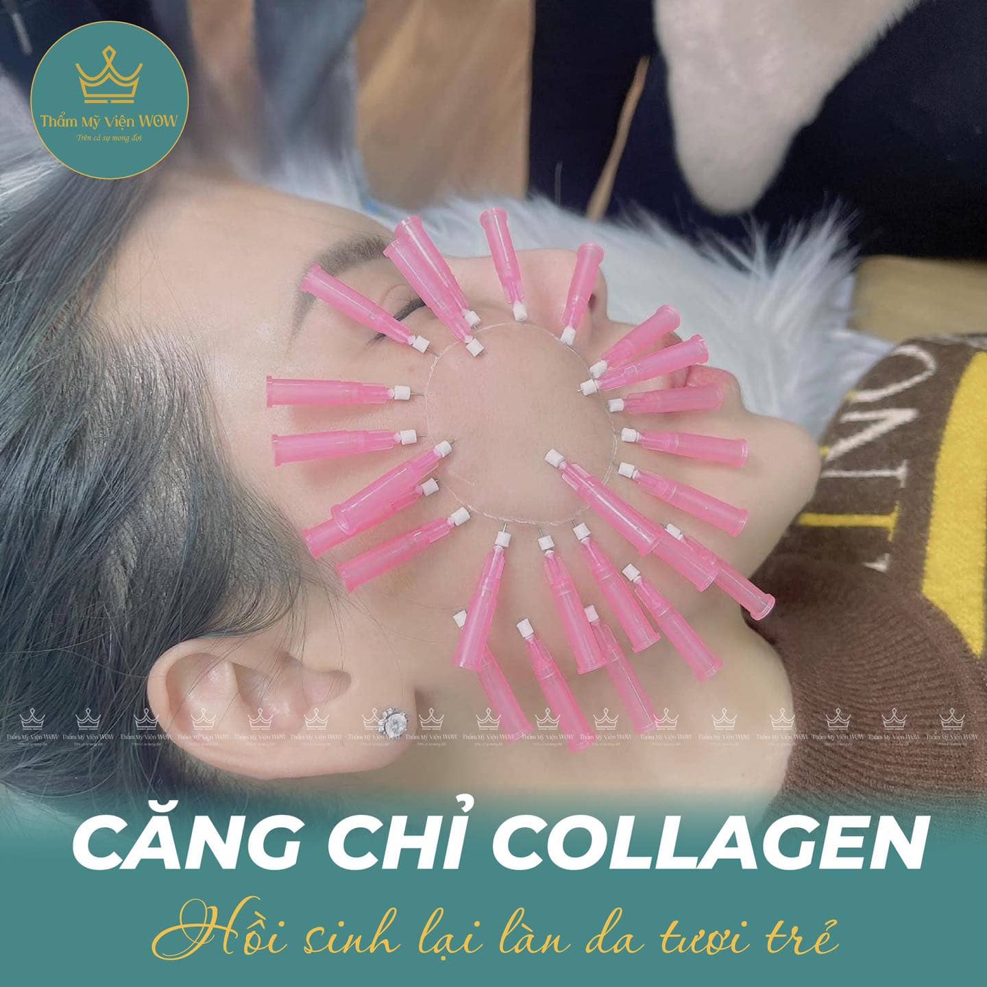 Căng chỉ collagen có an toàn không
