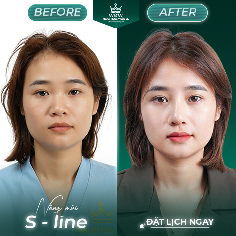 Chăm sóc sau nâng mũi tại Phòng khám Thẩm mỹ WOW