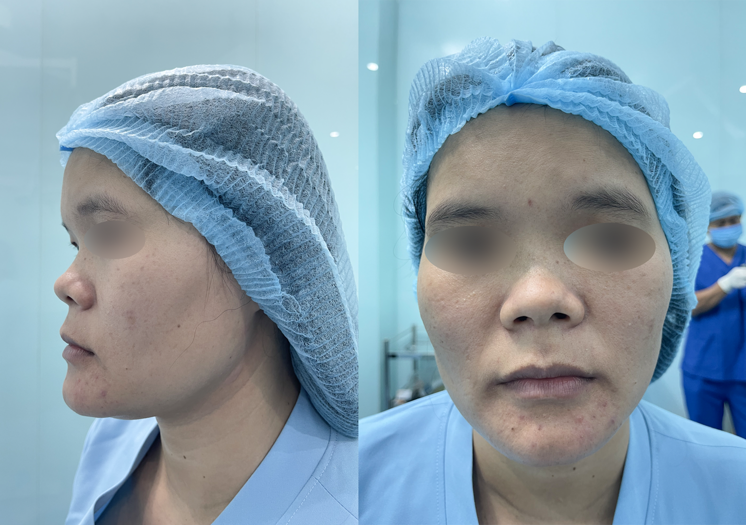 Tư vấn nền mũi thấp và dáng mũi hài hòa với gương mặt