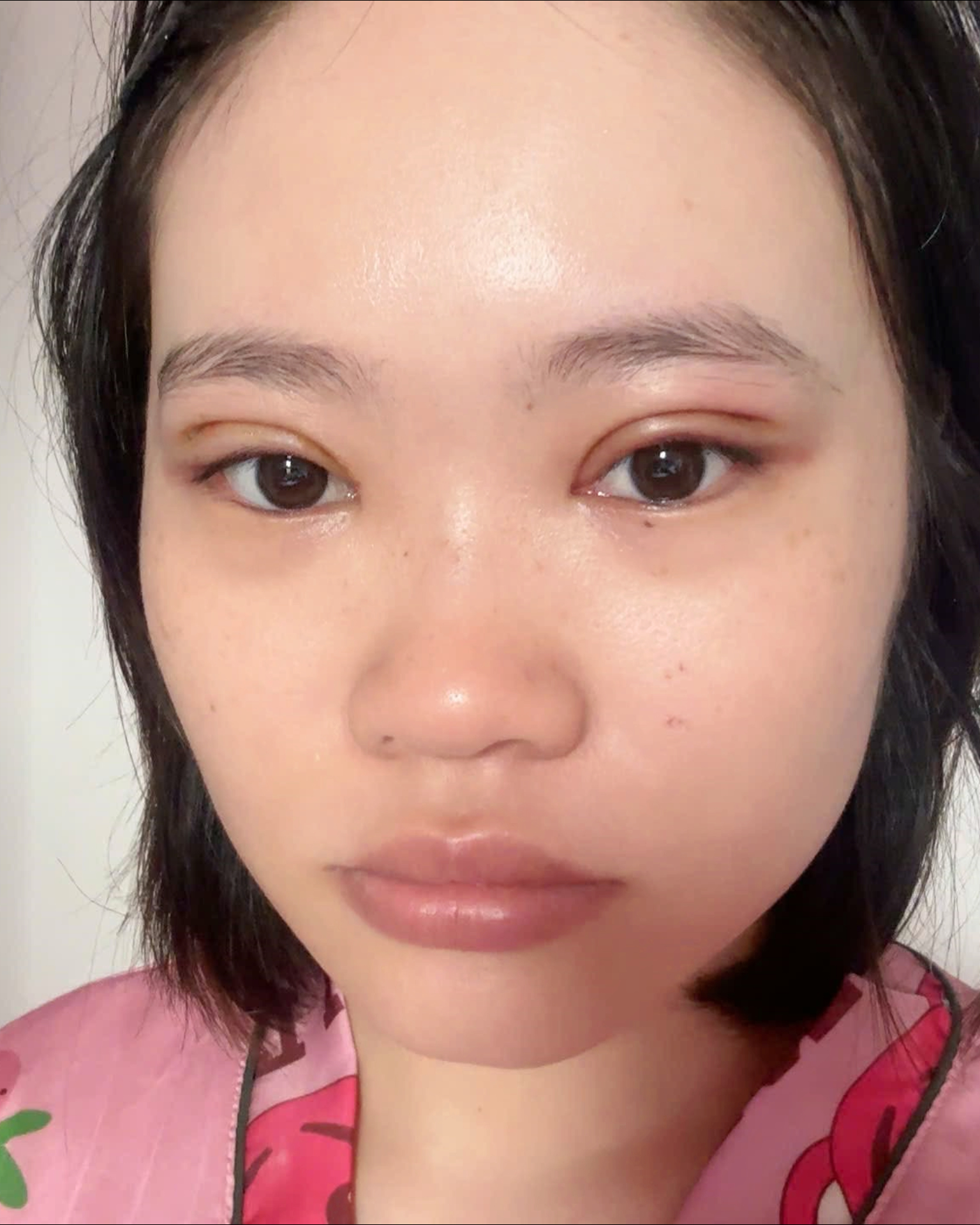 Quá trình hồi phục mí mắt sau cắt mí tại WOW