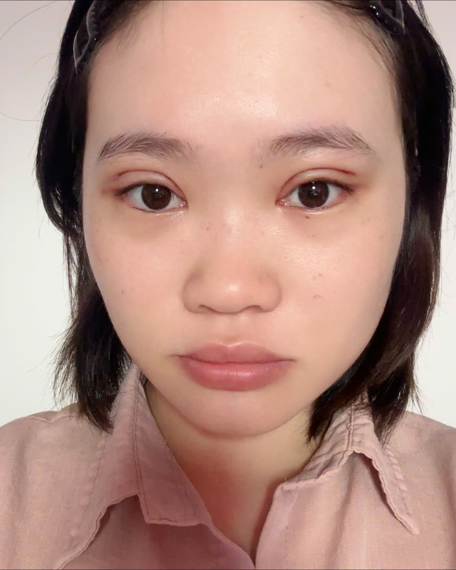 Minh họa nếp mí sau giai đoạn hồi phục ban đầu