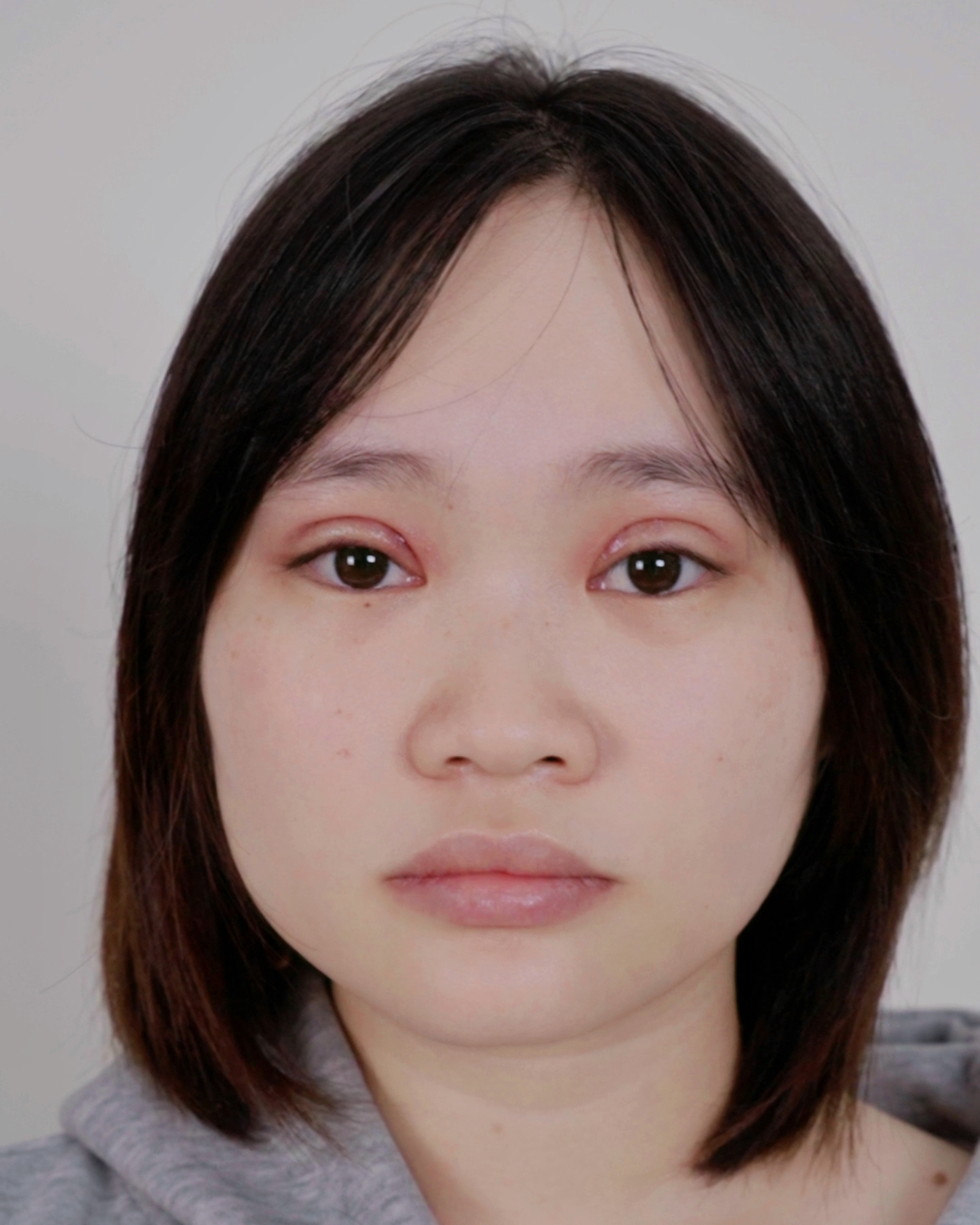 Hình ảnh chăm sóc và cắt chỉ sau cắt mí tại WOW