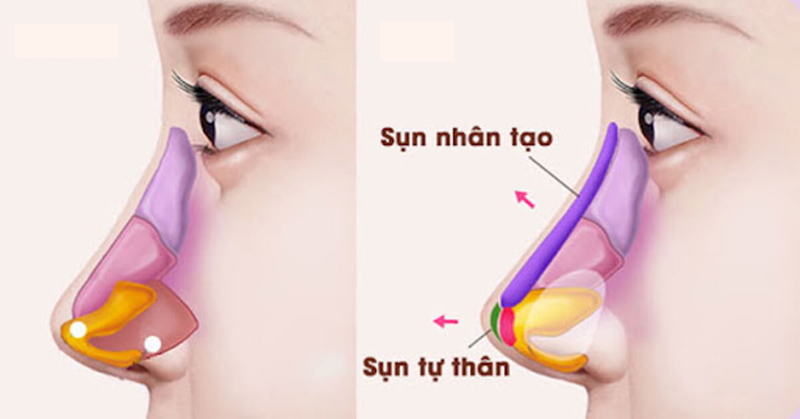Tư vấn lựa chọn phương pháp nâng mũi phù hợp nền mũi